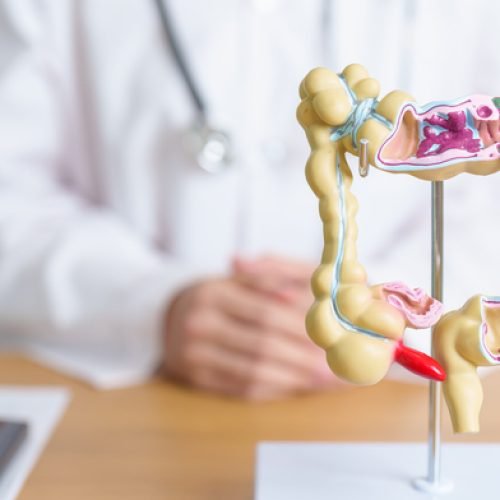 Doctor with human Colon anatomy model. Colonic disease, Large Intestine, Colorectal cancer, Ulcerative colitis, Diverticulitis, Irritable bowel syndrome, Digestive system and Health concept