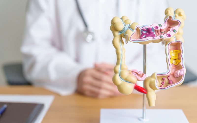 Doctor with human Colon anatomy model. Colonic disease, Large Intestine, Colorectal cancer, Ulcerative colitis, Diverticulitis, Irritable bowel syndrome, Digestive system and Health concept
