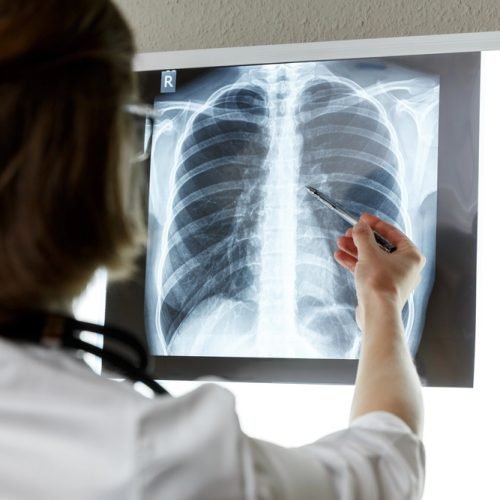 Indústria é condenada a indenizar viúva e filhos de trabalhador que morreu de fibrose pulmonar