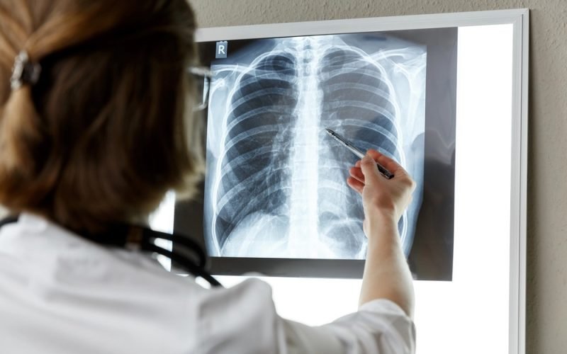 Indústria é condenada a indenizar viúva e filhos de trabalhador que morreu de fibrose pulmonar